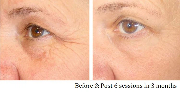 Eyes Before After 2