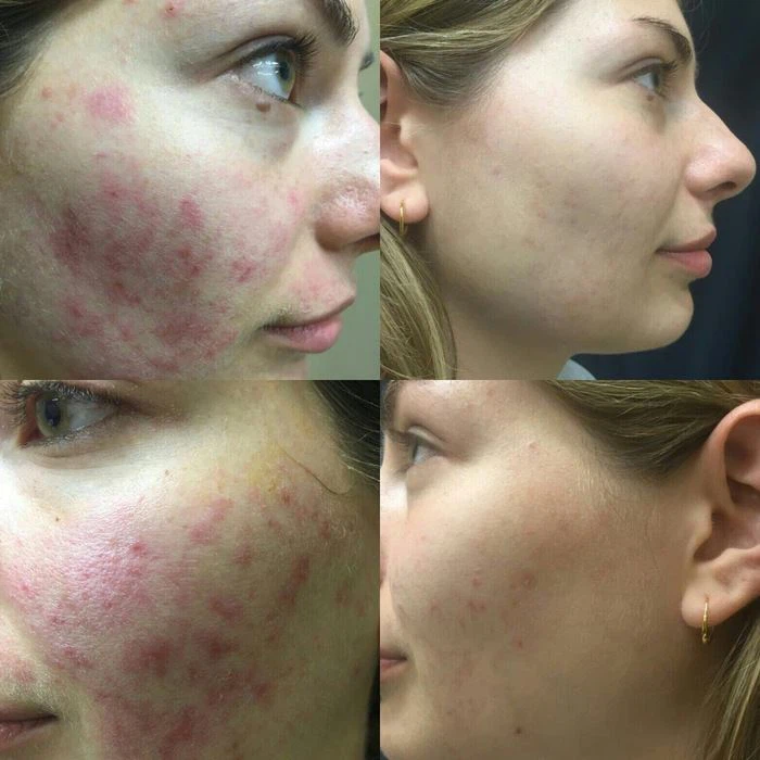 Carbon Peel Acne before after