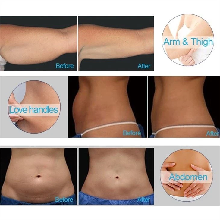 Cryolipolysis Cooling Cryolipolysisy Anti-Cellulite Fat Freezing Slimming Machine